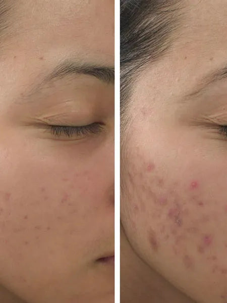 GlamHubMehru-Acne_whiteningFaceBar_4