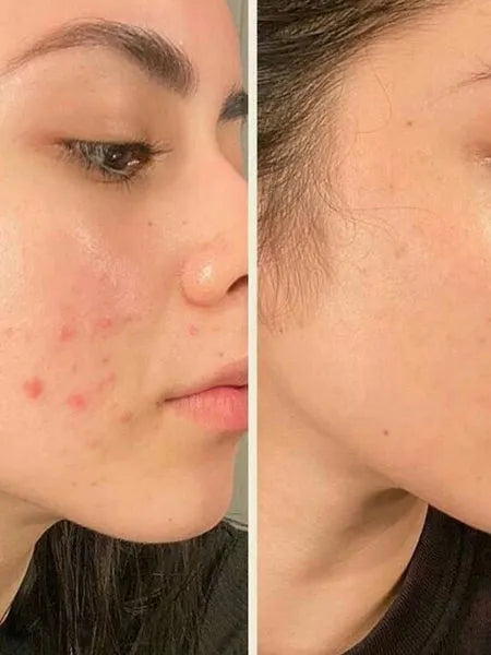 GlamHubMehru-Acne_whiteningFaceBar_5